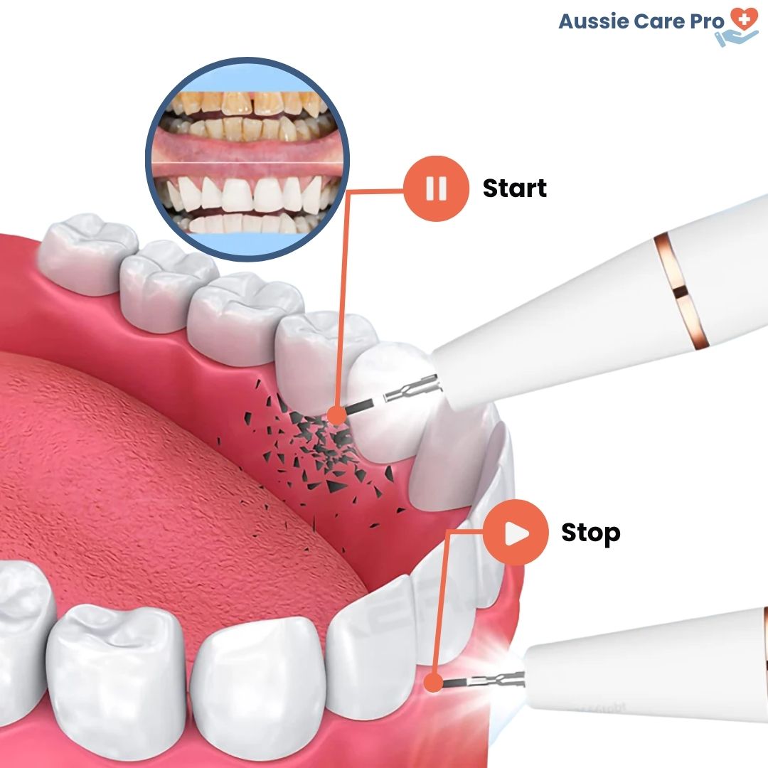 Ultrasonic dental cleaner device, blue, with removable tips for plaque removal, USB rechargeable, ensuring whiter teeth at ho
