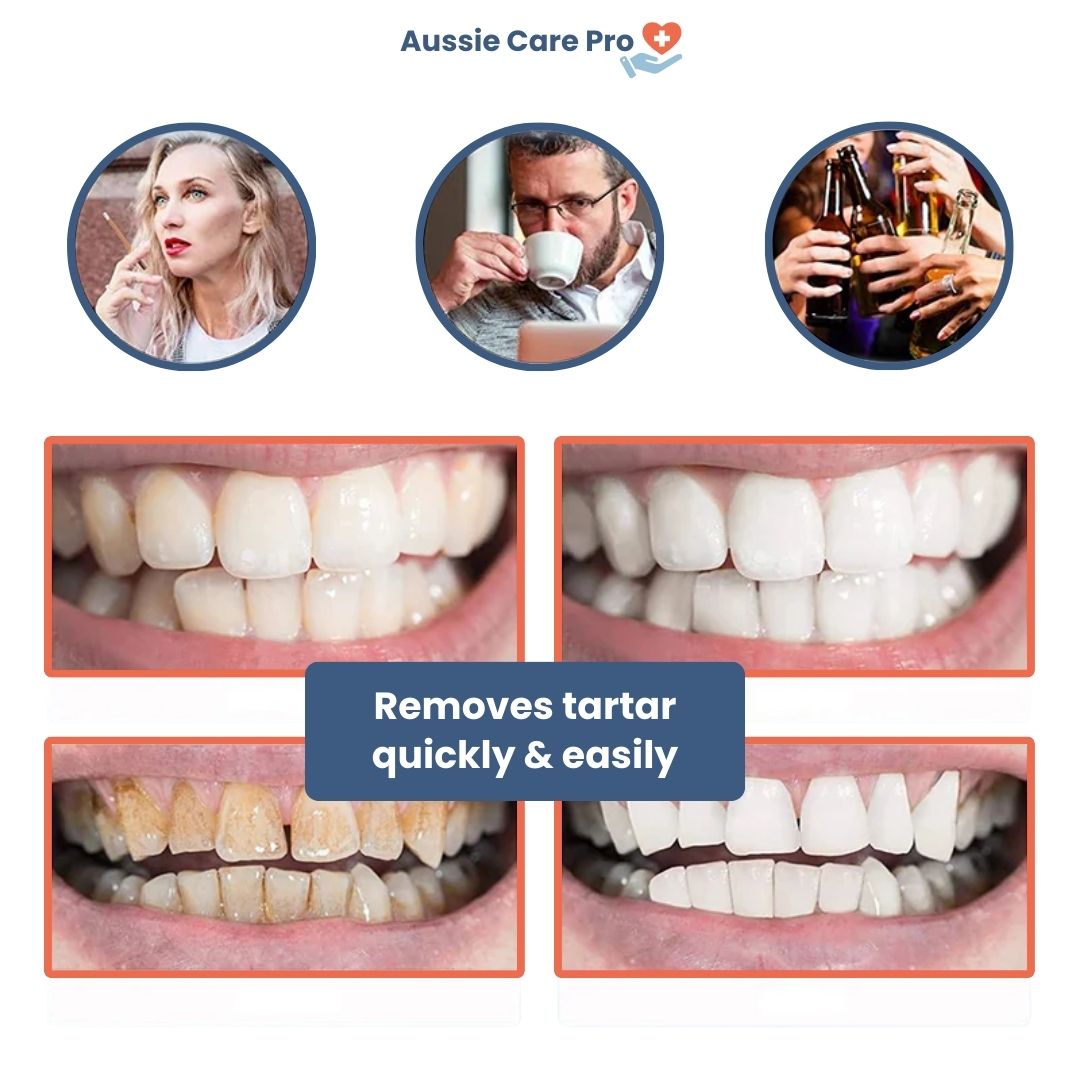 Ultrasonic dental cleaner device, blue, with removable tips for plaque removal, USB rechargeable, ensuring whiter teeth at ho