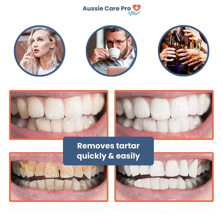 Ultrasonic dental cleaner device, blue, with removable tips for plaque removal, USB rechargeable, ensuring whiter teeth at ho