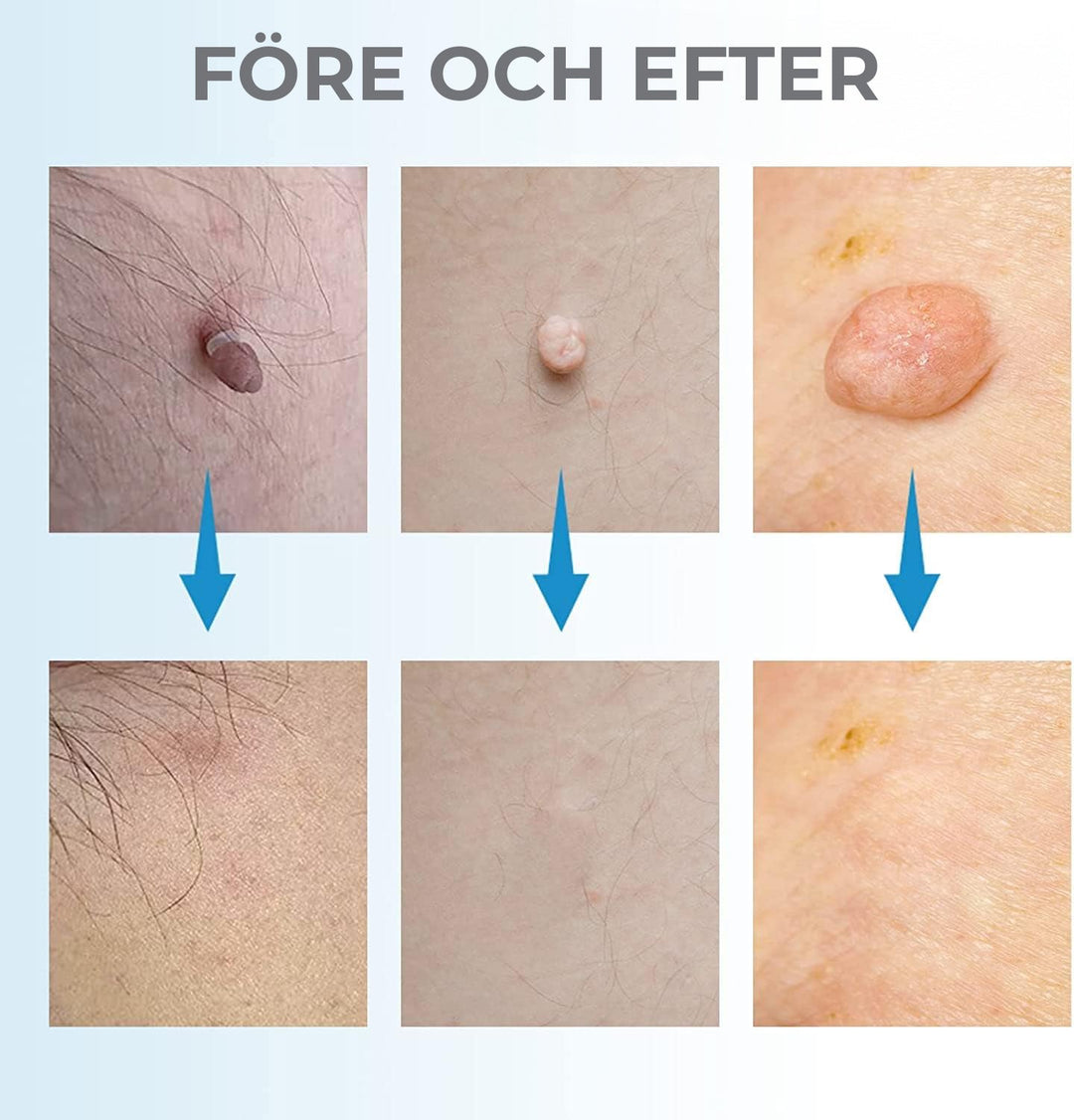 Natural skin imperfection remover kit. Effective at-home treatment for skin tags, warts & seborrheic keratosis.