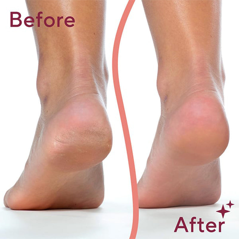 Handheld electric pedicure device, callus remover for effective foot skin care and smoothing