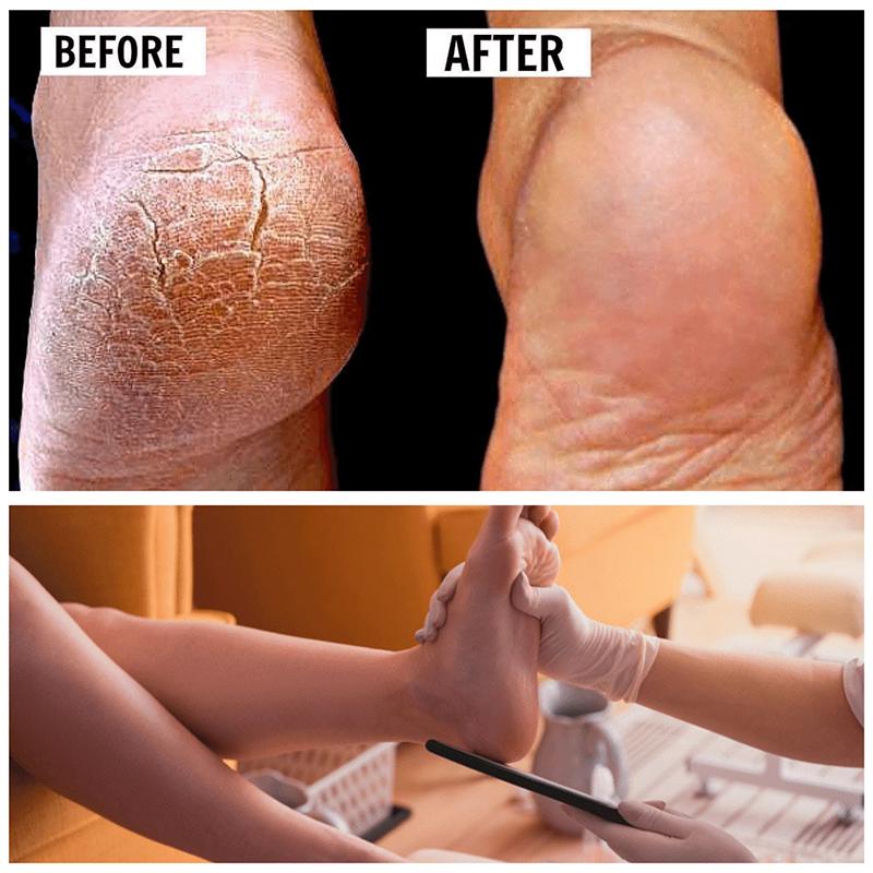 High-quality foot exfoliator and callus remover, a beauty and skin care tool for smooth feet.