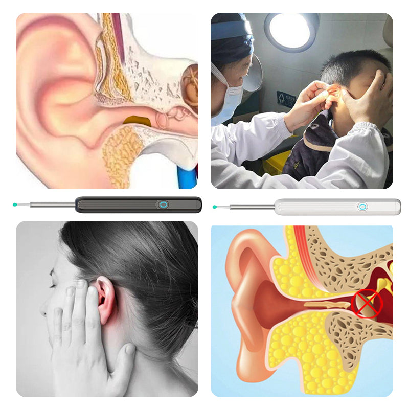 Smart visual ear cleaner kit, including the device, charging cable, and various ear wax removal tips.