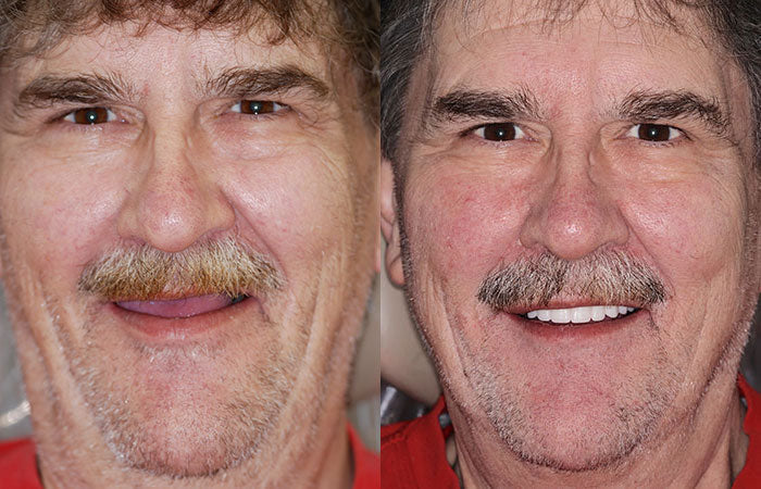 Full custom dentures in ivory & white shades, offering a natural fit and comfortable wear for daily life.