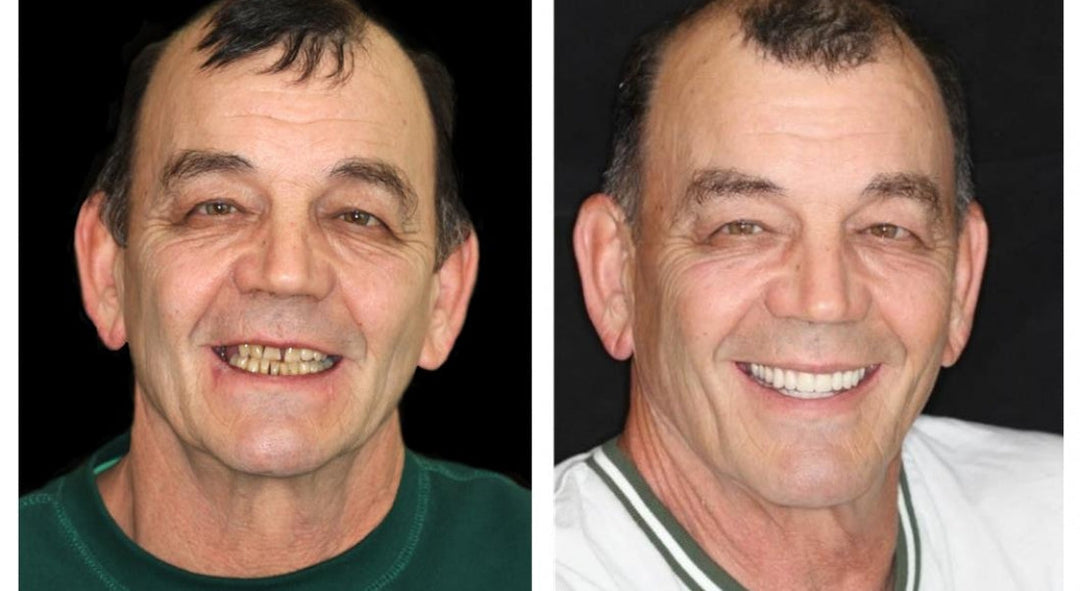 Personalized full dentures with a natural ivory & white appearance, ensuring comfort and a beautiful, confident smile.