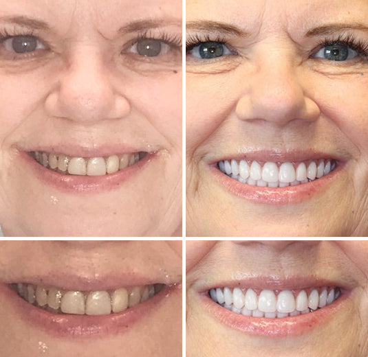 Enhance oral health with personalized natural fit dentures. Ivory & white teeth for a confident, comfortable smile.