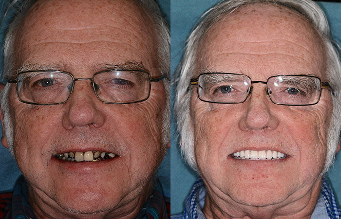 Natural fit ivory & white full dentures, custom made for comfort & a seamless, personalized look.