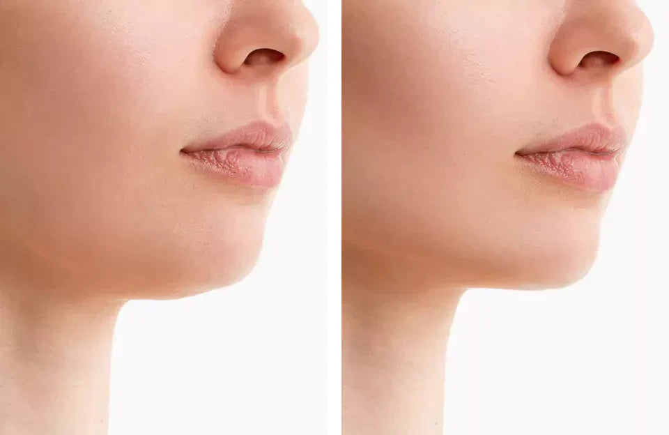 Advanced beauty tech: red light chin device for anti-aging, jawline sculpting & firming facial treatment.