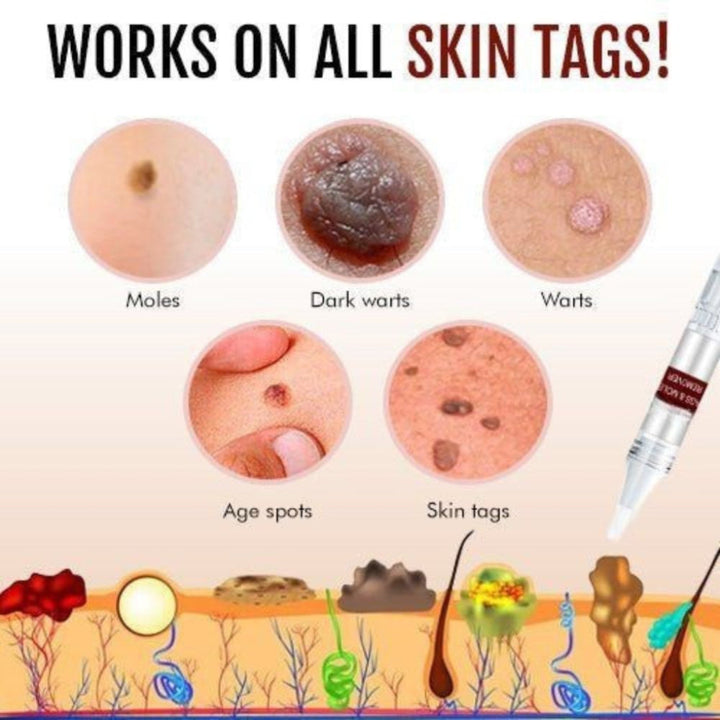 Close-up of Skin Tag & Mole Remover Pen, a natural home remedy with tea tree oil for clear, smooth skin.