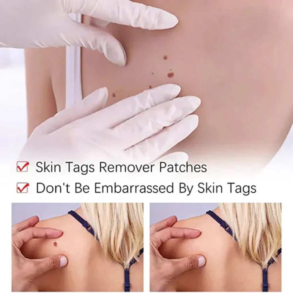 Unisex Skin Tag & Mole Remover Pen packaging, highlighting its natural treatment for painless mole & skin tag removal.