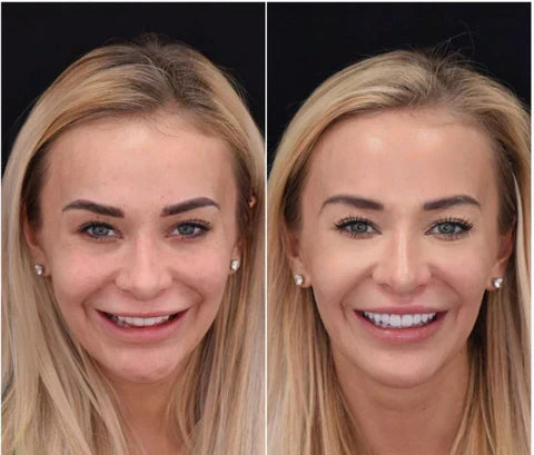 Man smiling confidently with natural-looking unisex snap-on dental veneers.