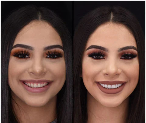 Woman's bright, instant smile enhanced by removable snap-on cosmetic veneers.