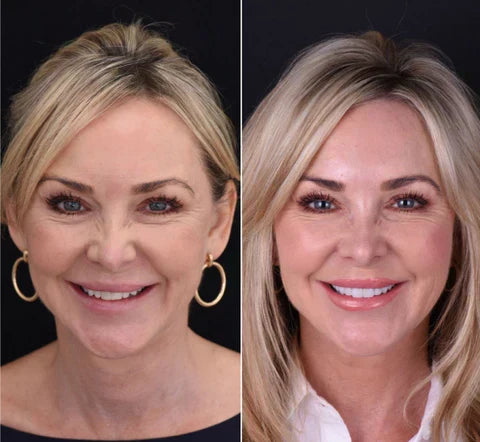 Portable snap-on veneers kit for a quick, natural smile fix, easy to carry.